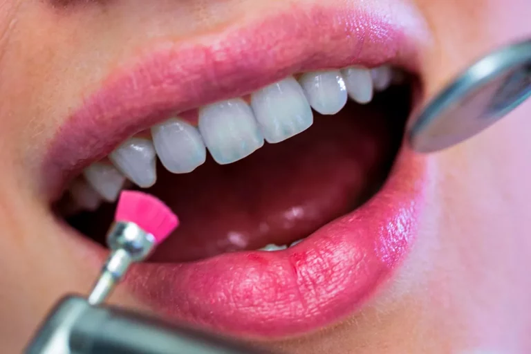 Limpieza dental profesional.