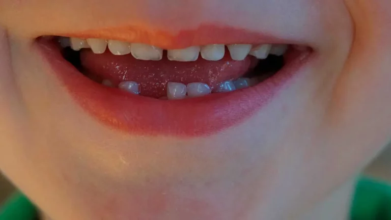 La atención Dental desde la infancia es crucial en la vida de las personas.