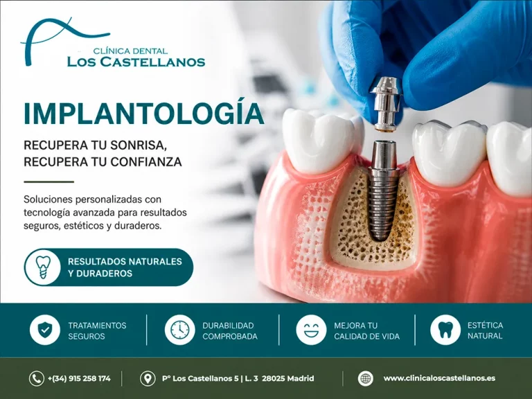 Implante Dental